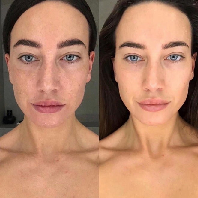TCA 15% Peeling