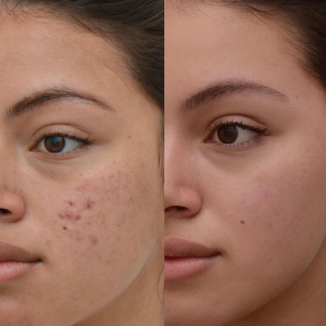 Dermatology - Acne Therapy