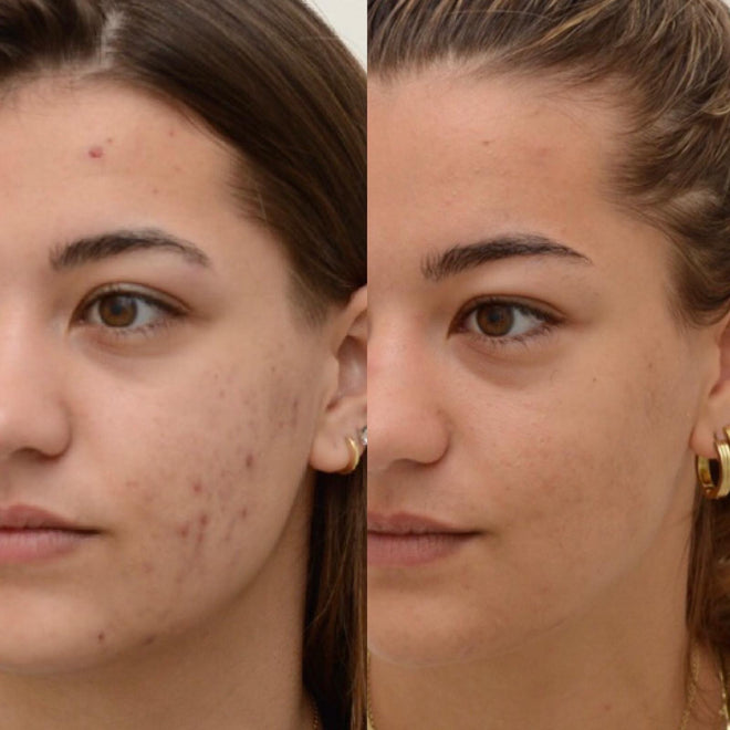 Dermatology - Acne Therapy