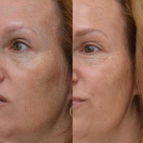 Dermatology - Hyperpigmentation Therapy